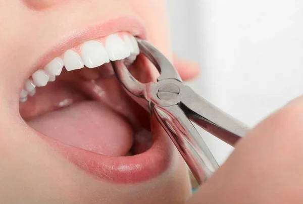 EXTRACTION / MINOR SURGERY