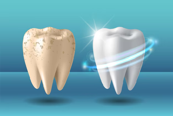 TEETH WHITENING