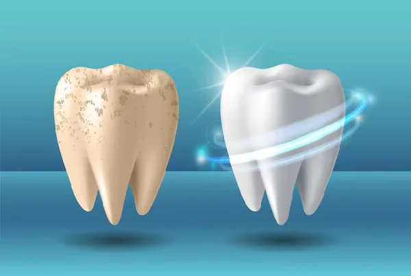 TEETH WHITENING
